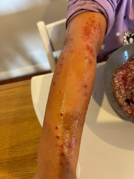 What has helped our daughter's eczema journey